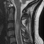 ¿Qué es el Infarto de la médula espinal?