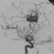 Malformaciones cerebrales arteriovenosas