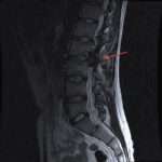 ¿Qué son las fístulas arteriovenosas espinales durales?