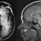 Tumores intracraneales primarios