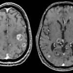 Tumores metastásicos intracraneales