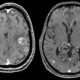 Tumores metastásicos intracraneales
