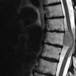 Tumores espinales primarios y metastásicos