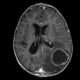 Absceso cerebral
