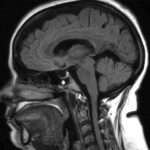 Hipertensión intracraneal idiopática