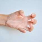 Distrofia Torsional Idiopática