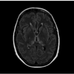 ¿Qué es la encefalopatía de Wernicke?