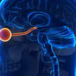 ¿Qué es la Neuromielitis óptica?