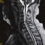 Lesión traumática de la médula espinal