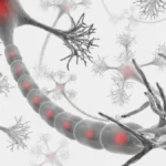 Polineuropatía inflamatoria crónica