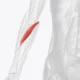 ¿Cuál es el Pronador Teres o Síndrome Interóseo anterior?