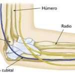 Lesiones del nervio cubital