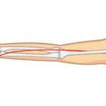 Lesiones del nervio radial
