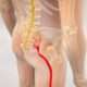 ¿Que es la parálisis del nervio ciático y fibular (peroneal común)?
