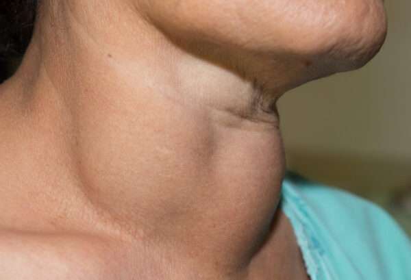 Nódulos tiroideos y bocio multinodular