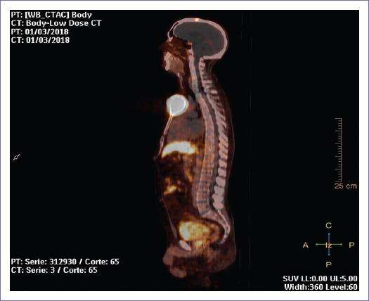 Feocromocitoma y Paraganglioma Metastásicos