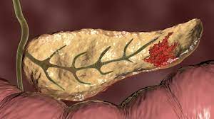 Hipoglucemia debida a tumores de células beta pancreáticas