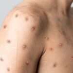Mpox