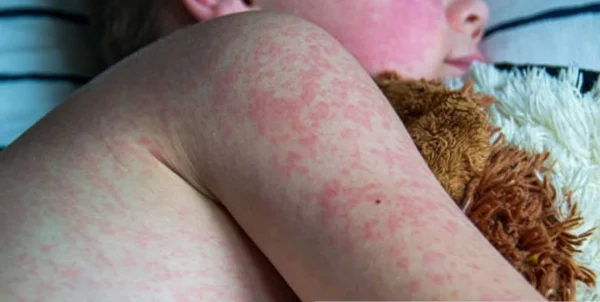 Infecciones por Eritroparvovirus