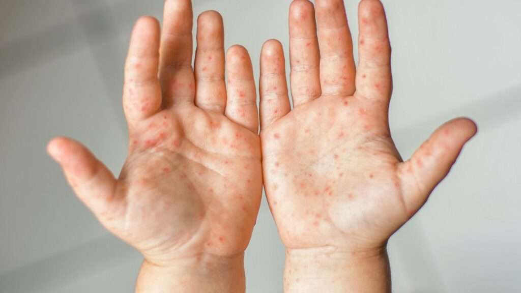 Síndromes causados por la infección por el Coxsackievirus
