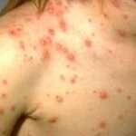 Pox rickettsial