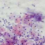 Actinomicosis