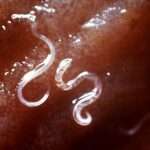 Anquilostomiasis