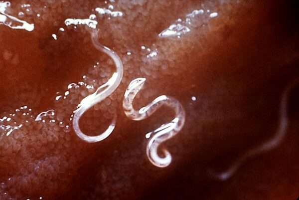 Anquilostomiasis