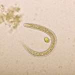 Estrongiloidiasis