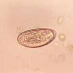 Enterobiasis