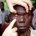Oncocercosis