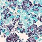 Histoplasmosis