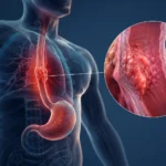 Cáncer de esófago