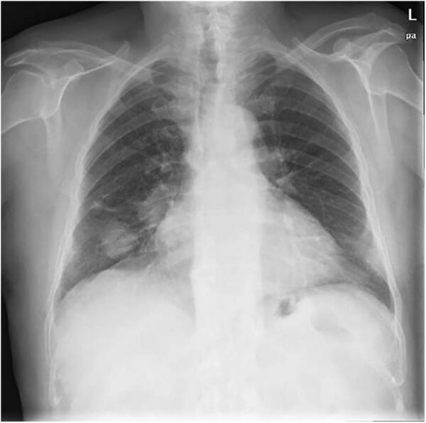 Diagnóstico de carcinoma broncogénico