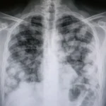 Metástasis pulmonares