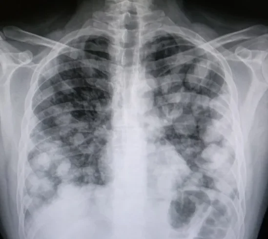 Metástasis pulmonares