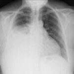 Mesotelioma
