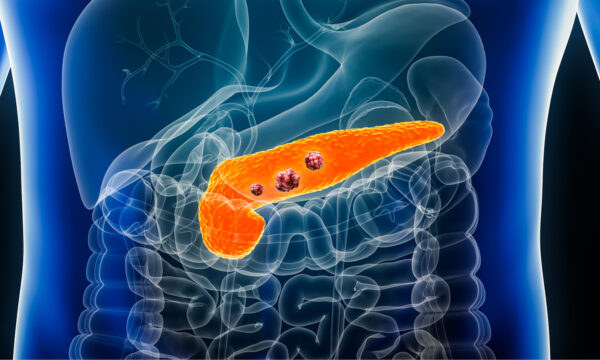 Carcinoma del páncreas y de la ampolla de Vater