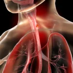 Cáncer de esófago