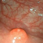 Tumores neuroendocrinos gástricos