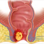 Carcinoma del ano