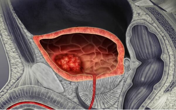 Cáncer de vejiga
