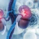Cánceres del uréter y de la pélvis renal
