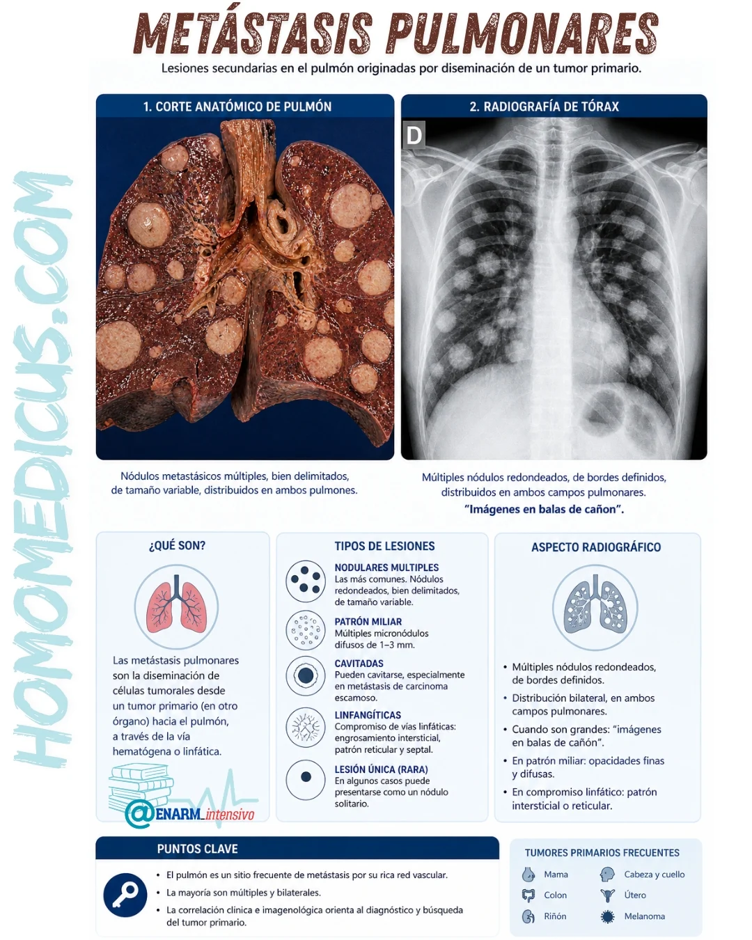 METÁSTASIS PULMONARES