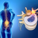 Hernia de disco lumbar