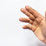 Contractura de Dupuytren