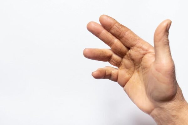 Contractura de Dupuytren
