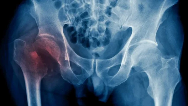 Fracturas de cadera
