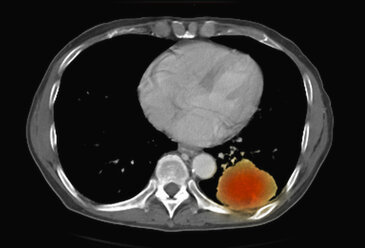 Técnicas de imagen alternativas para el estudio de las enfermedades pulmonares