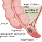 Inflamación del apéndice cecal